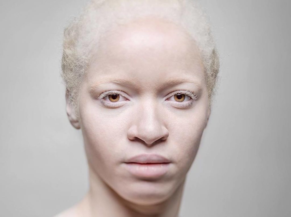 Нетрадиционная борьба с коронакризисом: колдуны стали чаще убивать альбиносов